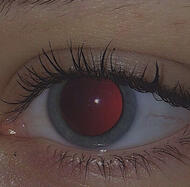 dilated pupil